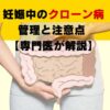 妊娠中のクローン病管理