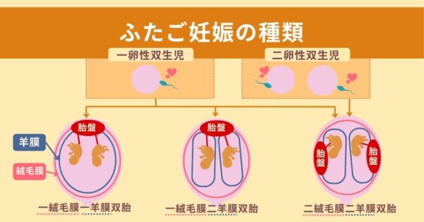 ふたごNIPTの種類